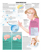 Плакат А3. Эпилепсия