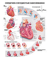 Плакат А3. Сердечно-сосудистые заболевания
