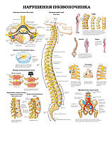 Плакат А3. Нарушения позвоночника Ламінація