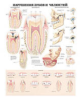 Плакат А3. Нарушения зубов и челюстей Ламінація
