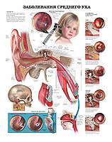 Плакат А3. Заболевания среднего уха