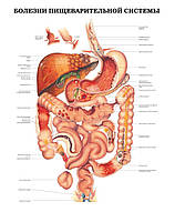Плакат А3. Болезни пищеварительной системы