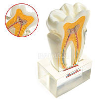 Демонстраційні моделі одного зуба Pathological Molar No3