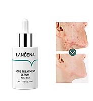 Сыворотка для лица Lanbena Acne Treatment Serum против акне и темных пятен, 30 мл