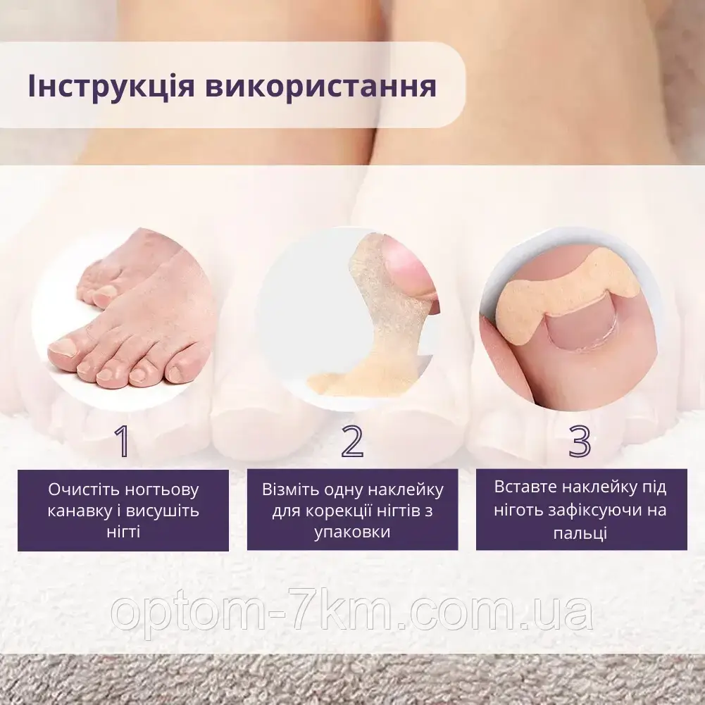 Набор пластырей Elastic Toenail Correction Sticker для безболезненной коррекции вросших ногтей Jw - фото 4 - id-p2076813841