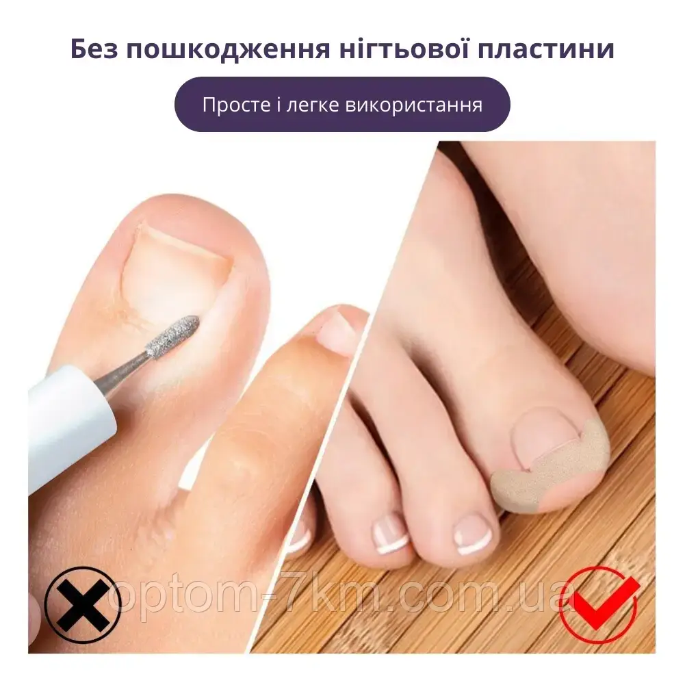 Набор пластырей Elastic Toenail Correction Sticker для безболезненной коррекции вросших ногтей Jw - фото 9 - id-p2076813841