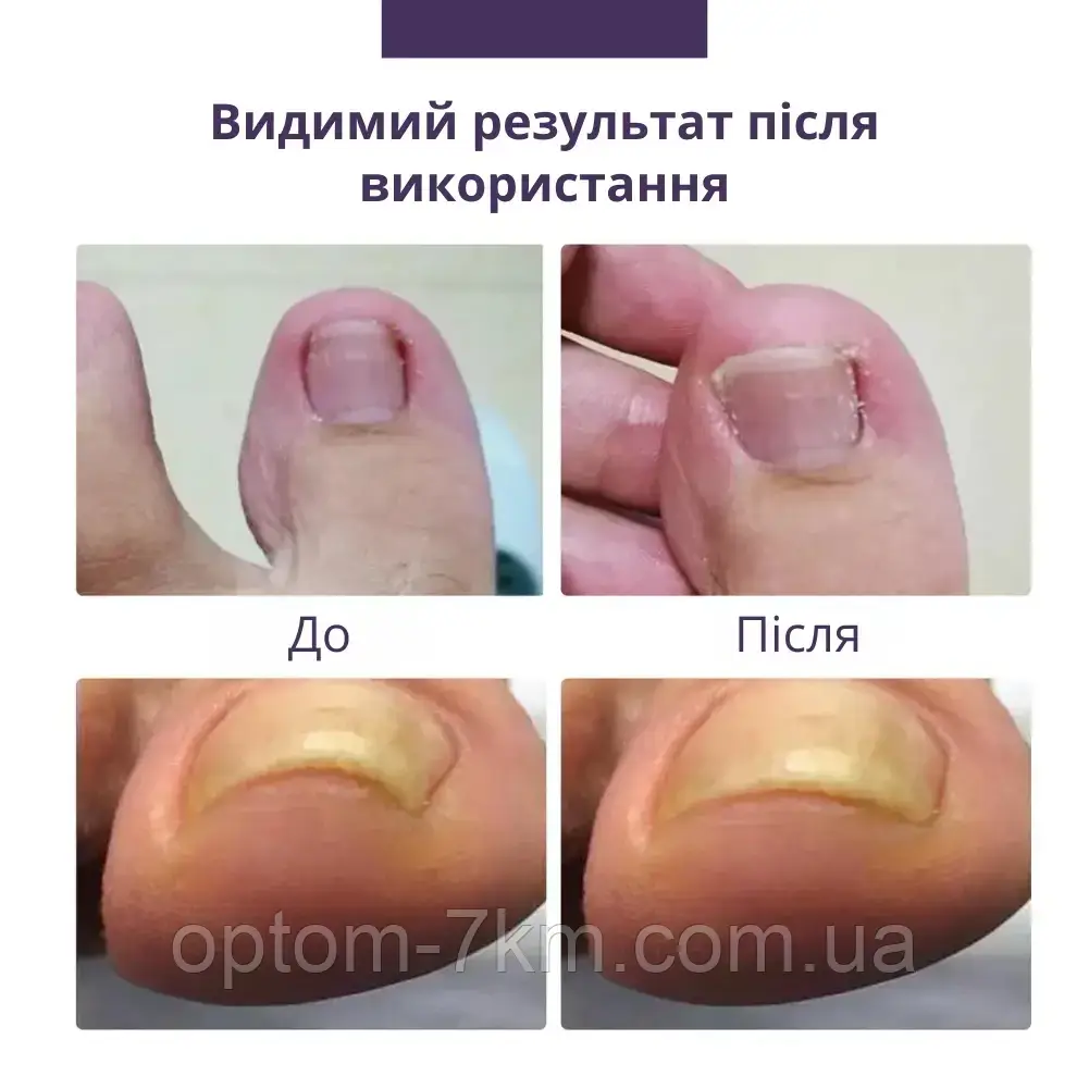 Набор пластырей Elastic Toenail Correction Sticker для безболезненной коррекции вросших ногтей Jw - фото 2 - id-p2076813841