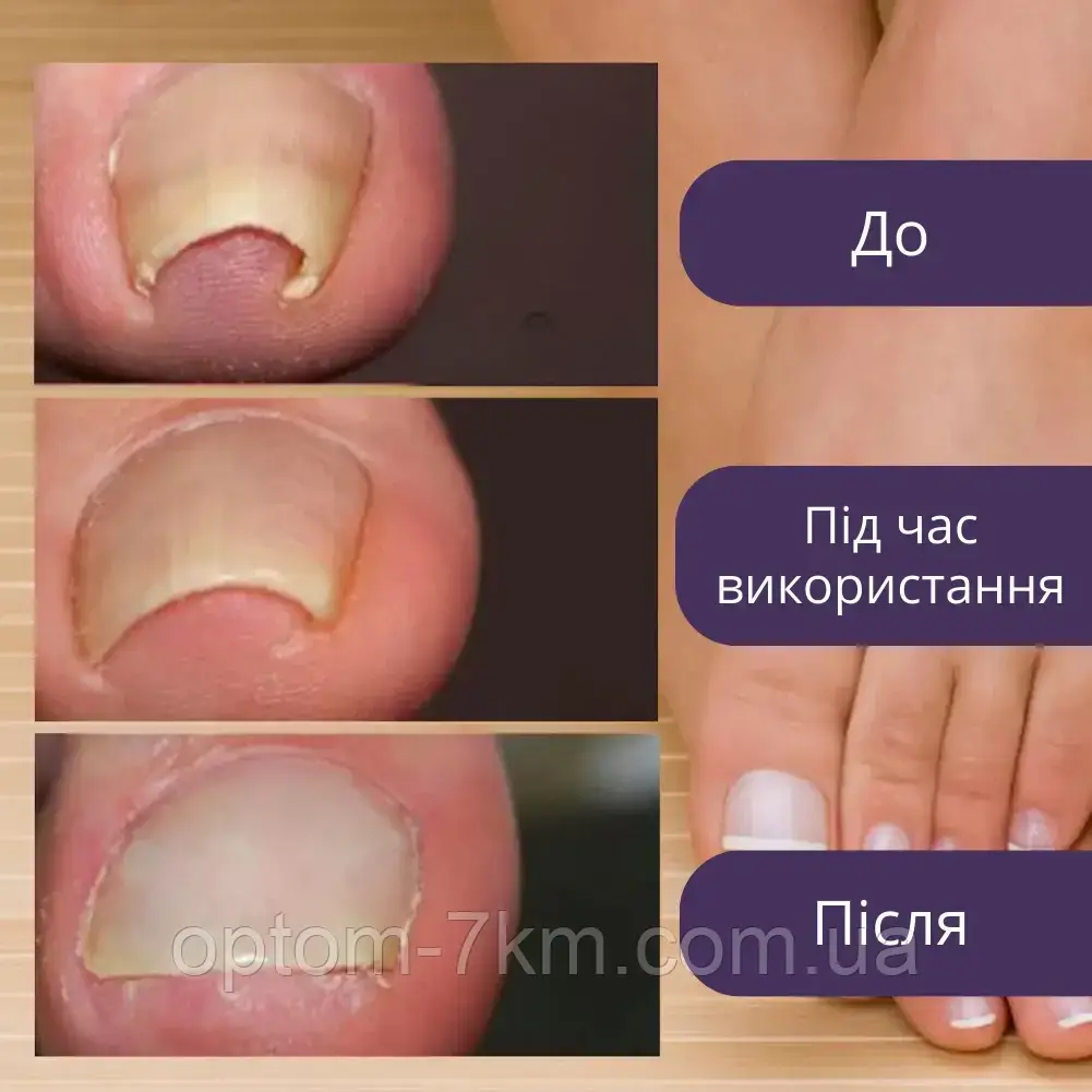 Набор пластырей Elastic Toenail Correction Sticker для безболезненной коррекции вросших ногтей Jw - фото 8 - id-p2076813841