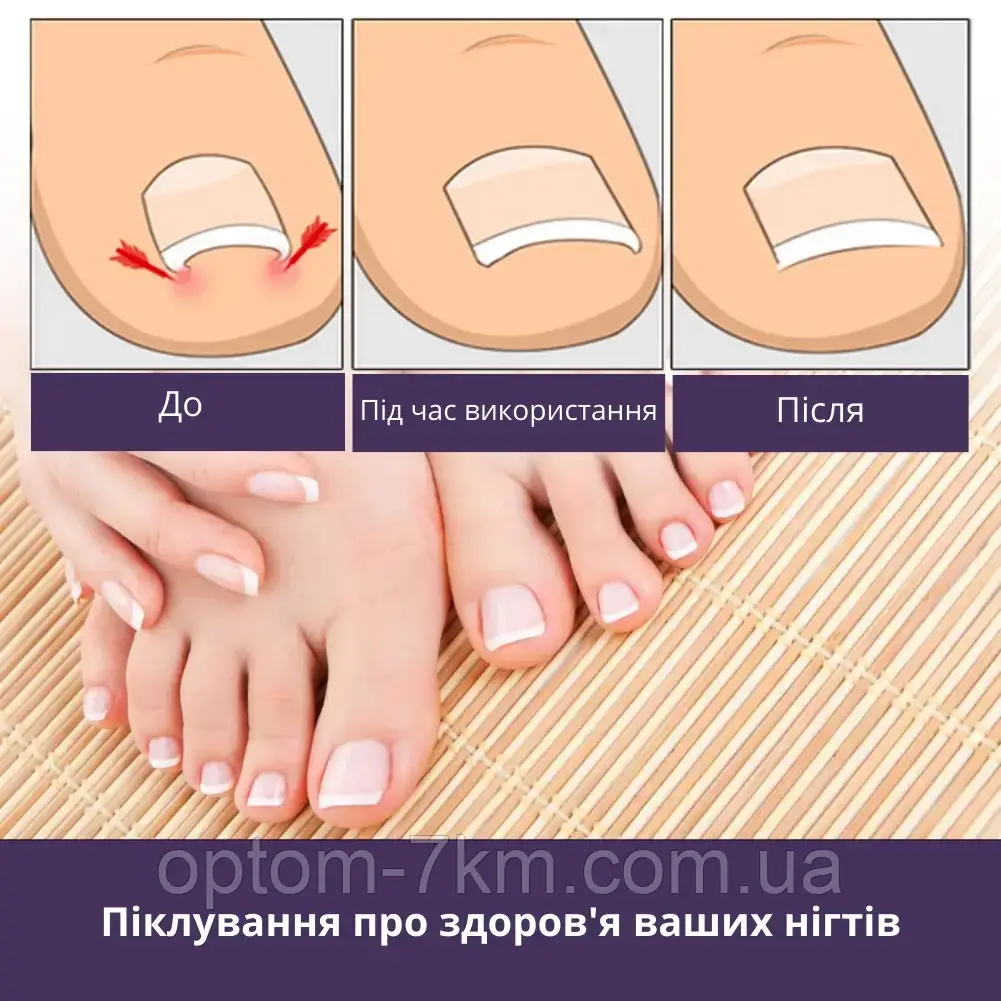 Набор пластырей Elastic Toenail Correction Sticker для безболезненной коррекции вросших ногтей Jw - фото 7 - id-p2076813841