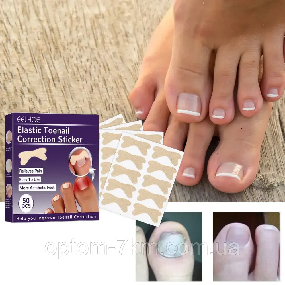 Набір пластирів Elastic Toenail Correction Sticker для безболісної корекції врослих нігтів Jw