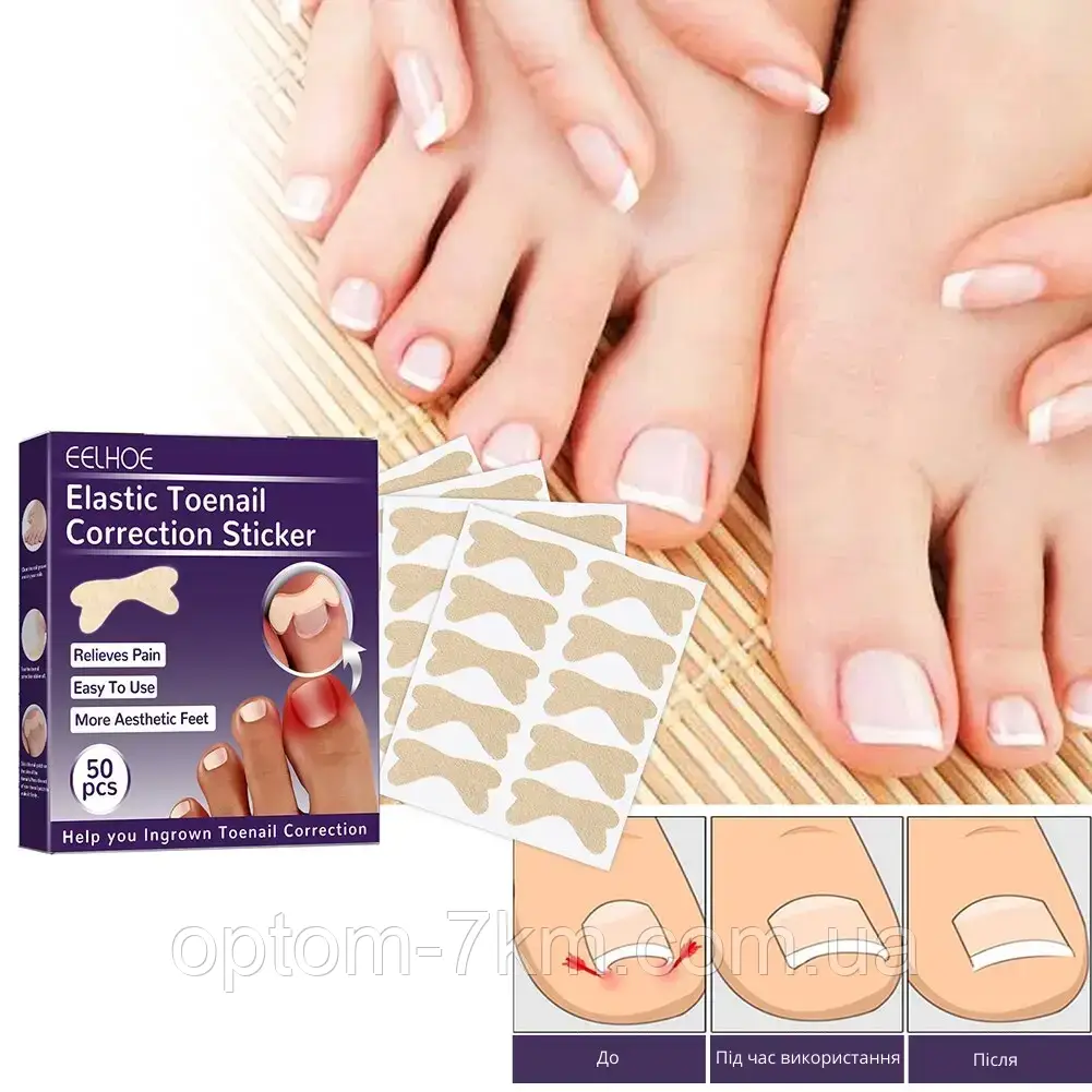 Набор пластырей Elastic Toenail Correction Sticker для безболезненной коррекции вросших ногтей Jw - фото 3 - id-p2076813841