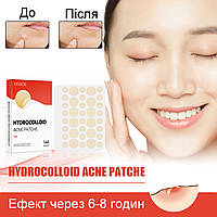 Пластир від акне та прищів Hydrocolloid Acne Patche 144 шт