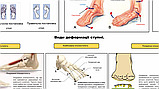 Плакат Анатомії та деформація стопи 86×67 см Демонстраційний плакат для пацієнтів Медичний плакат, фото 2