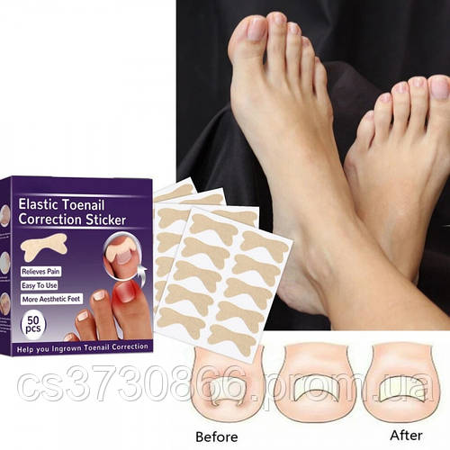 Пластырь для вросших ногтей Пластырь для безболезненной коррекции ...