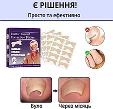 Набір пластирів Elastic Toenail Correction Sticker для корекції та усунення врослих нігтів (50 шт.)  YU227, фото 3