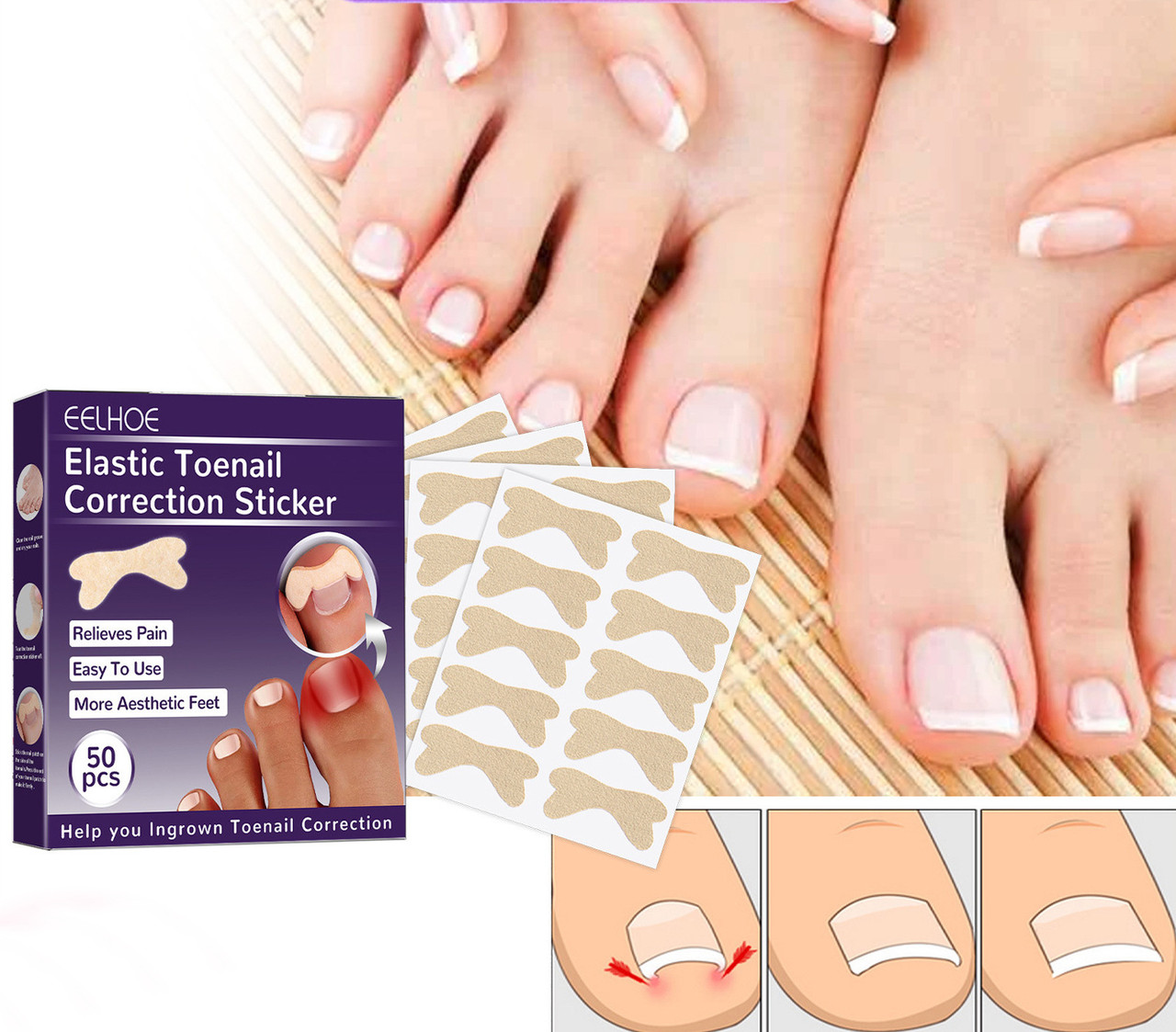Набір пластирів для корекції врослих нігтів Elastic Toenail Correction Sticker 50 шт, фото 1