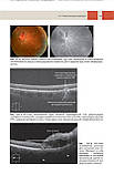 Дакер Дж.С. Оптична когерентна томографія сітківки 2021 рік, фото 6