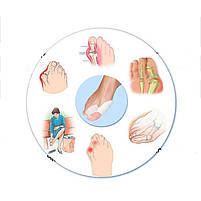 Фіксатор великого пальця ноги при "кісточках" білі 1 пара (2 шт). Кісточки на ногах гелевий протектор, фото 4