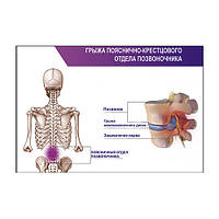 Плакат Vivay Грыжа пояснично-крестцового отдела позвоночника А0 (4689) LD, код: 6863117