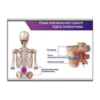 Плакат Vivay Грыжа пояснично-крестцового отдела позвоночника с планкой А1 (9044) ON, код: 6759470