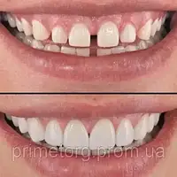 Виниры для зубов PERFECT SMILE VENEERS 4630 «H-s»