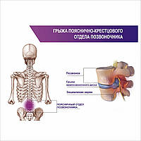 Плакат Грыжа пояснично-крестцового отдела позвоночника А1 QT, код: 6689095