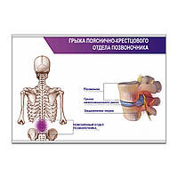Плакат Vivay Грижа попереково-крижового відділу хребта А0 (8863) XN, код: 6689103