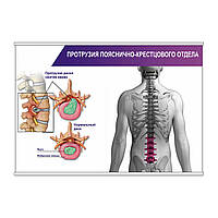 Плакат Vivay Протрузия пояснично-крестцового отдела А2 (8961) PZ, код: 6689122