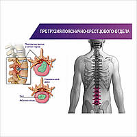 Плакат Vivay Протрузия пояснично-крестцового отдела А0 LW, код: 6689068