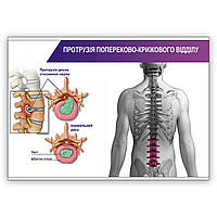 Плакат Vivay Протрузія попереково-крижового відділу А1 (8936) DH, код: 6688988