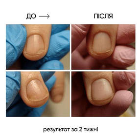 Олія від оніхолізису та грибка NAILSOFTHEDAY OniStop 15мл, фото 3
