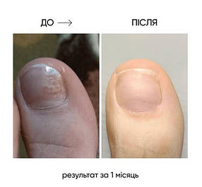 Олія від оніхолізису та грибка NAILSOFTHEDAY OniStop 15мл, фото 4