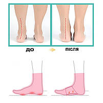 Силіконові ортопедичні супінатори під склепіння стопи білі 1 пара. Ортопедичні напівустілки для стопи, фото 6