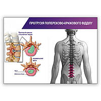 Плакат Протрузія попереково-крижового відділу А3