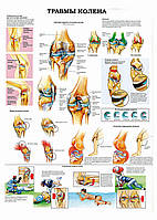 Травмы колена - постер