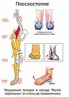 Плоскостопие - плакат