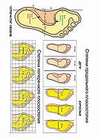 Степени продольного плоскостопия - плакат