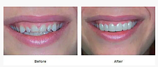Знімні вініри для зубів Snap-On Smile на верхні, нижні зуби (накладні зуби) - 1 шт, фото 3