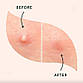 Патчи от прыщей и акне 72 шт Acne Patch / Пластырь косметический для лечения акне, фото 2