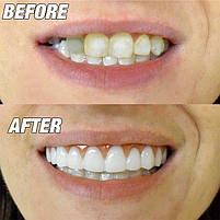 Вініри для зубів Perfect Smile Veneers: Знімні накладки для бездоганної посмішки. Накладки для зубів, фото 9