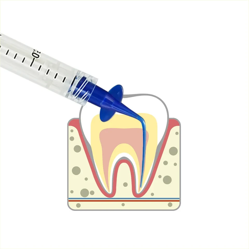 Ендо канюля для внесення матеріалу в канали 0.25mm (1шт)