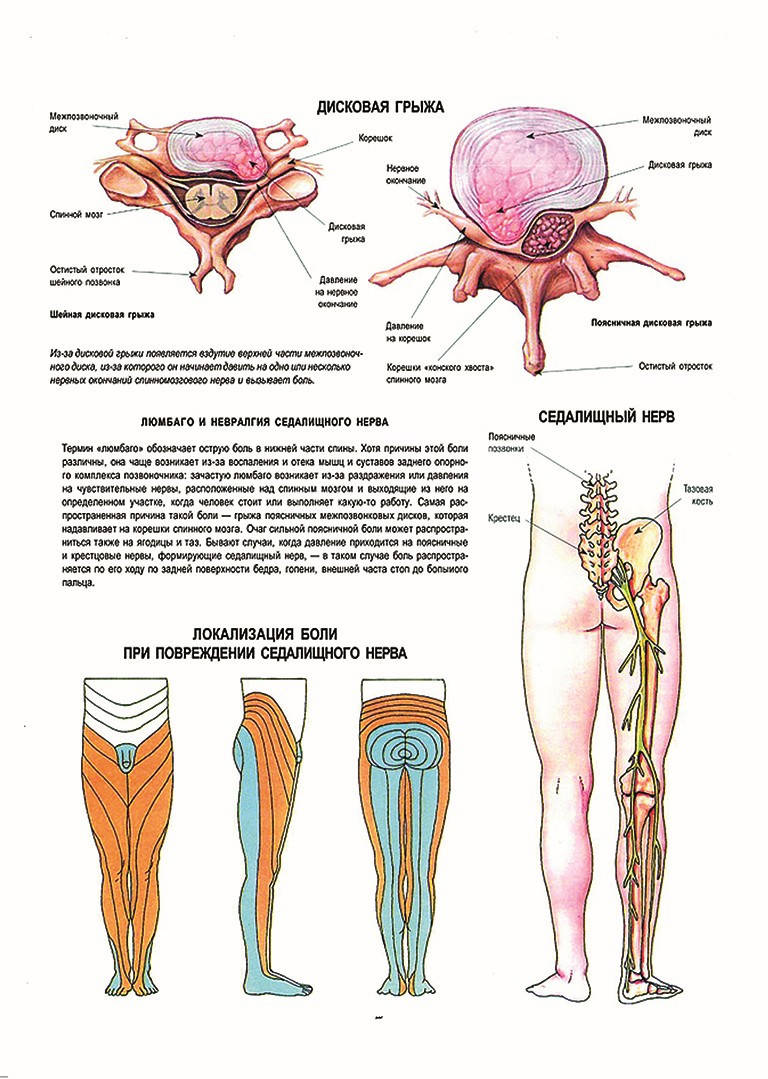 

Дисковая грыжа - плакат