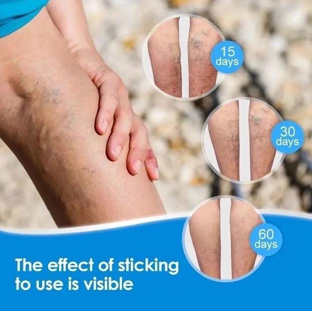 Пластир від варикозу, фото 1