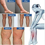 Пластир від варикозу, фото 2
