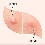 Пластир Від Бородавок або Прищів Acne Patch N72, фото 3