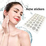 Пластир Від Бородавок або Прищів Acne Patch N72, фото 6