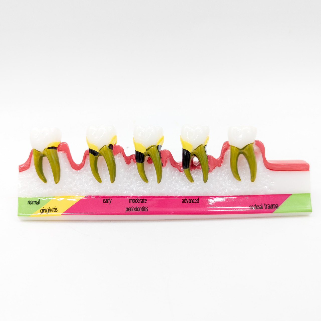 Стоматологічна модель пародонтальної патології, етапи пародонтиту, фантом
