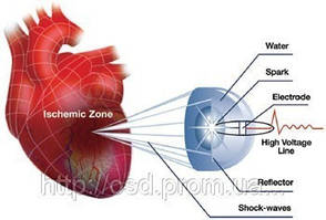 Ударно-хвильова терапія серцево-судинних захворювань Кардиоспек (Cardiospec)