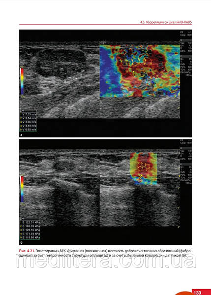 Ультразвуковая эластография. От простого к сложному Сенчу А.М. 2023 год, фото 7