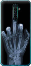 Чохол на Oppo Reno Ace Рука через рентген "1007u-1964-851"